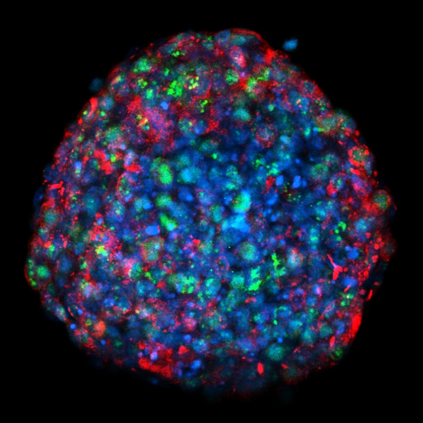 Confocal MIP image of a 8-day breast tumor spheroid mounted on an ibidi µ-Slide 18 well glass bottom