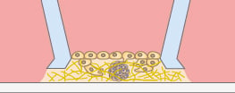 Potential tumor angiogenesis assay concept with the micro-Insert 3D